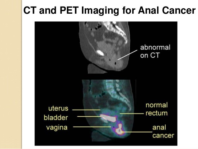 pet scan for anal cancer Great tit bird